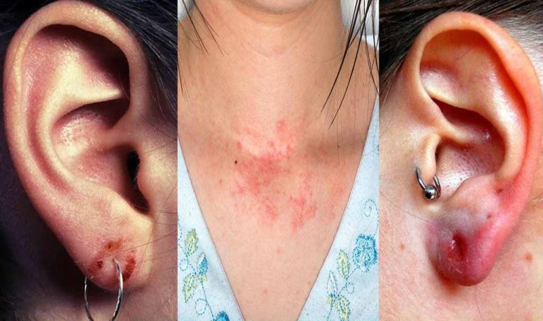 Best Metal For Sensetive Skin