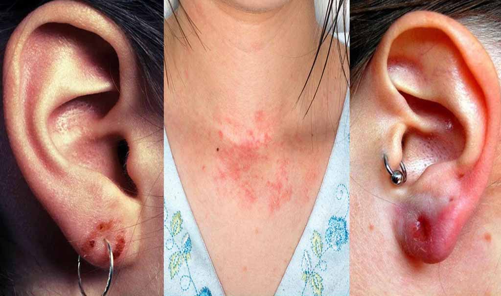 Best Metal For Sensetive Skin